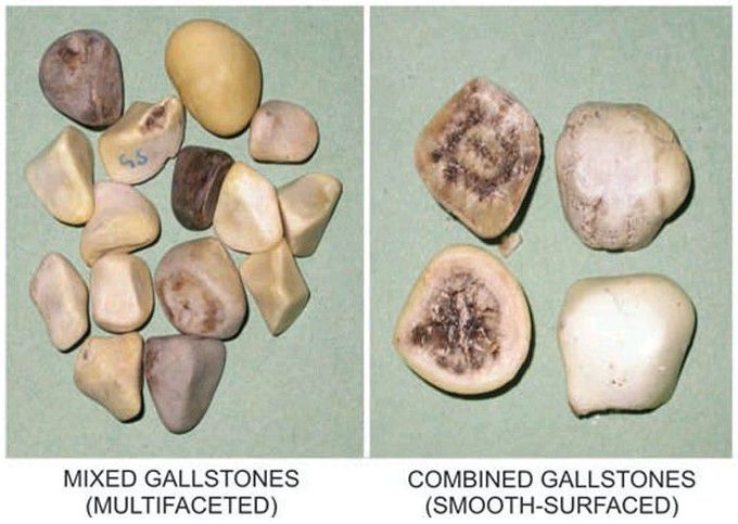 Gallstones