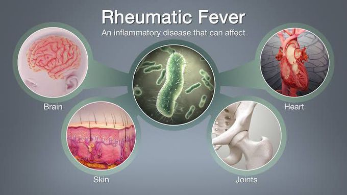 Jones Criteria for Diagnosis of Rheumatic Fever