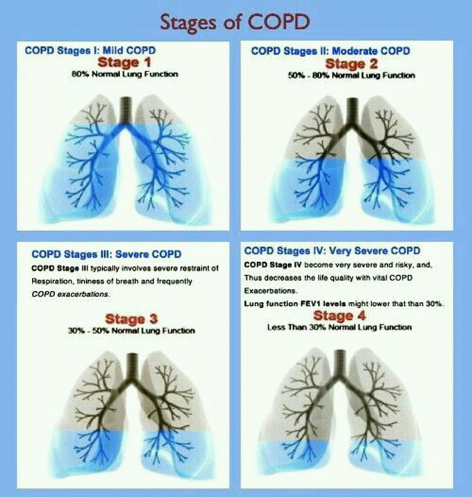 Stages of COPD