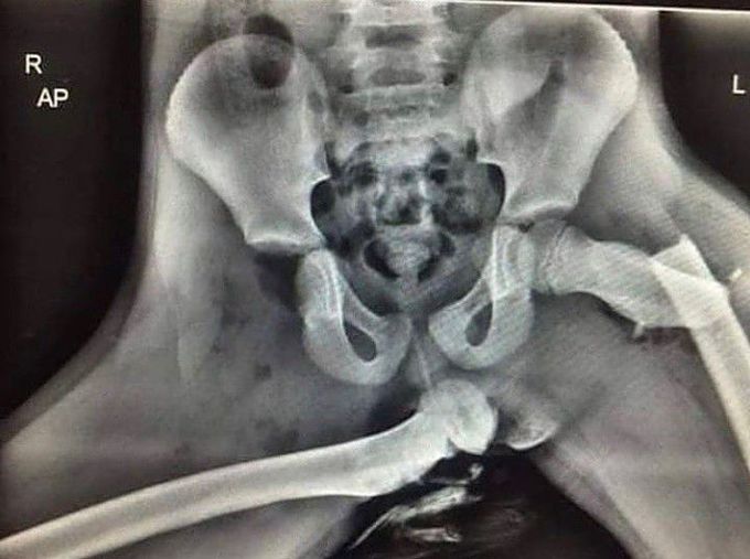 HORRIFYING X-RAY OF COMPLETE DISLOCATION !