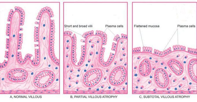 Malabsorption syndrome