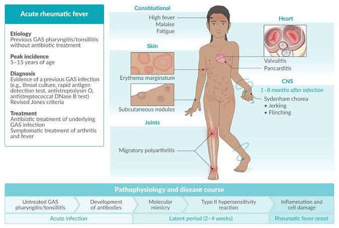 Causes of rheumatic fever