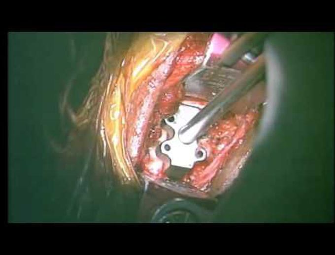 Two-level cervical arthroplasty using a “no-distraction” technique