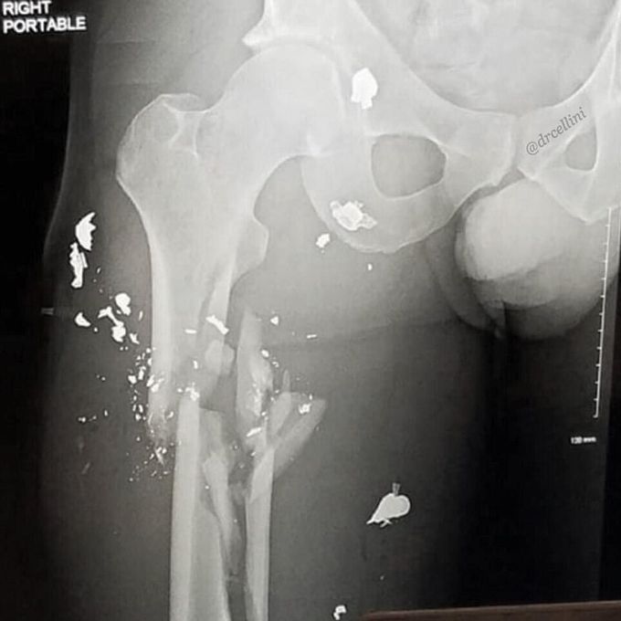 Comminuted fracture from AK-47! 