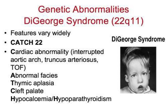 Following are the features of Digeorge's syndrome