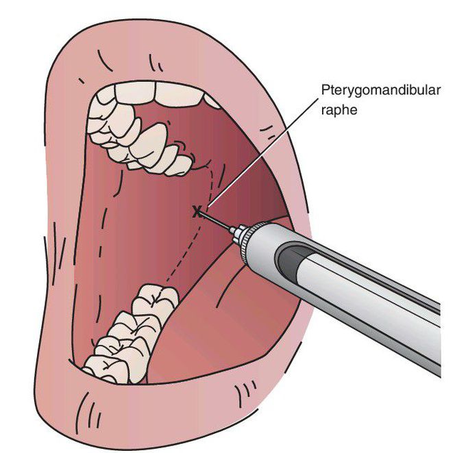 Inferior alveolar nerve block