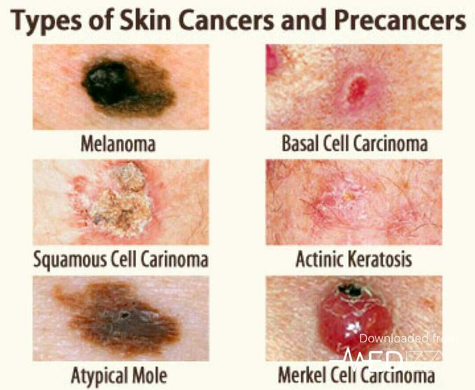 Types of malignant and premalignant skin cancer