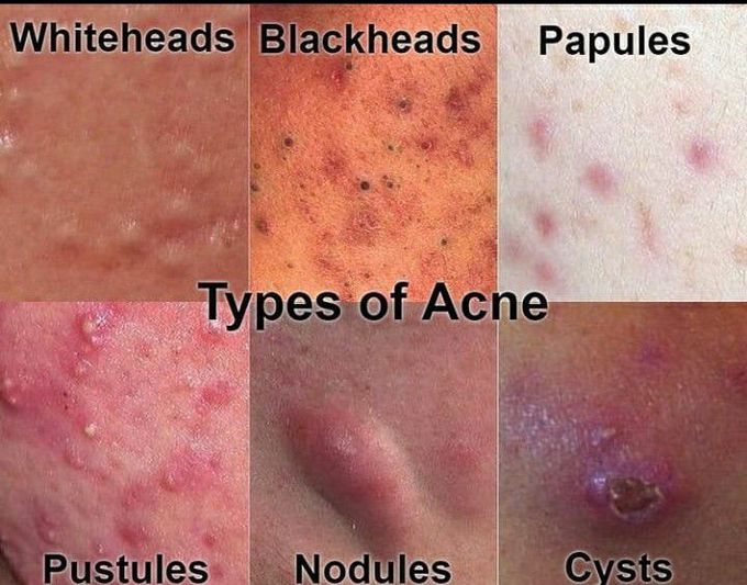 Derma