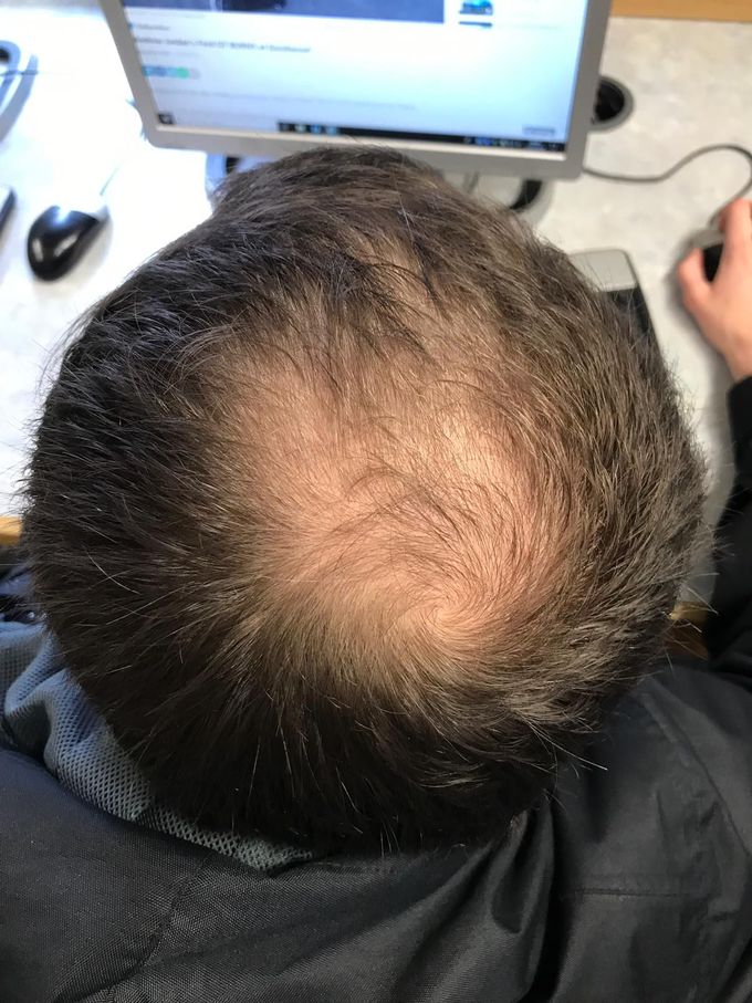 Androgenetic Alopecia