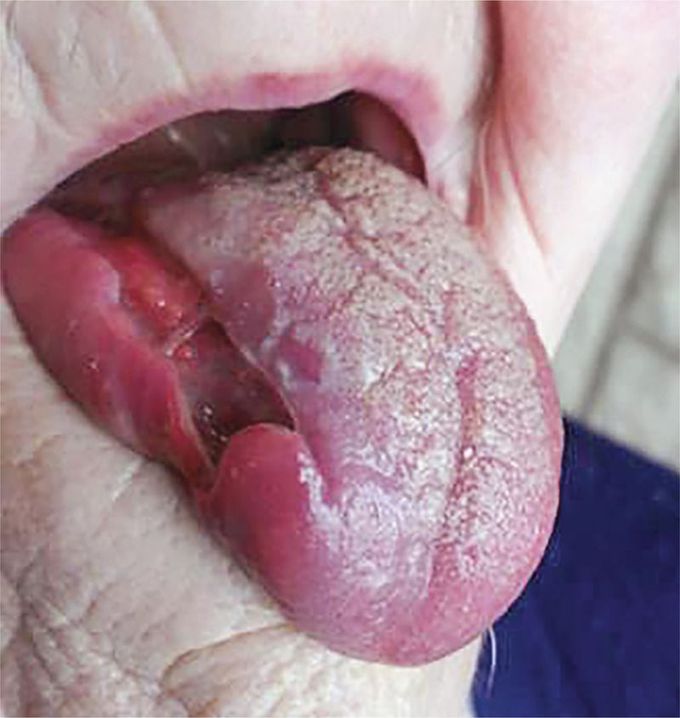 Tongue Necrosis in Giant-Cell Arteritis