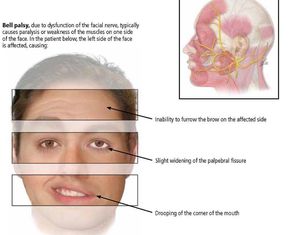 Bell's palsy. - MEDizzy