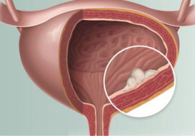 What is the probability of having bladder cancer based on the results of the analysis?