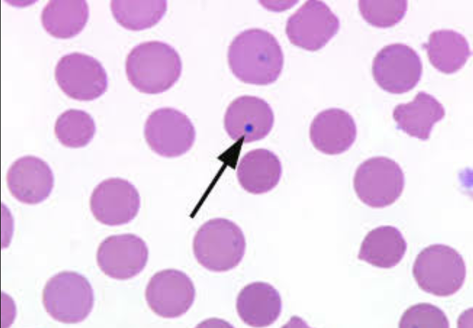 What is the histopathological finding seen in this image?