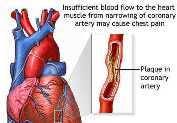 Coronary spasm, or unstable angina.