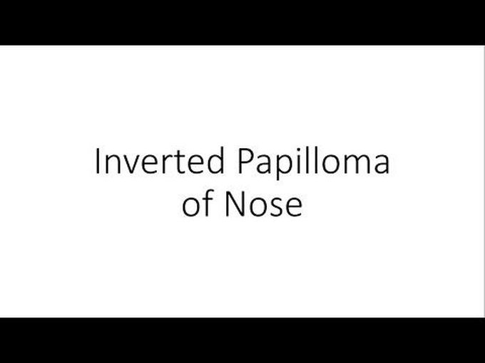 Introduction to Inverted Papilloma of Nose