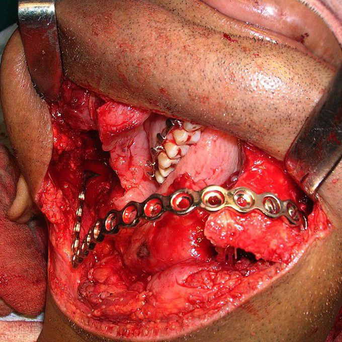 Ameloblastoma