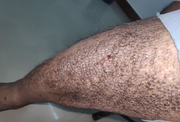 65 y/o male with T2 DM and HTN came with c/o irritation of skin and hyperpigmentation of the skin on both the legs and thighs for past 3 months..No c/o itching and pain..What is the probable diagnosis?