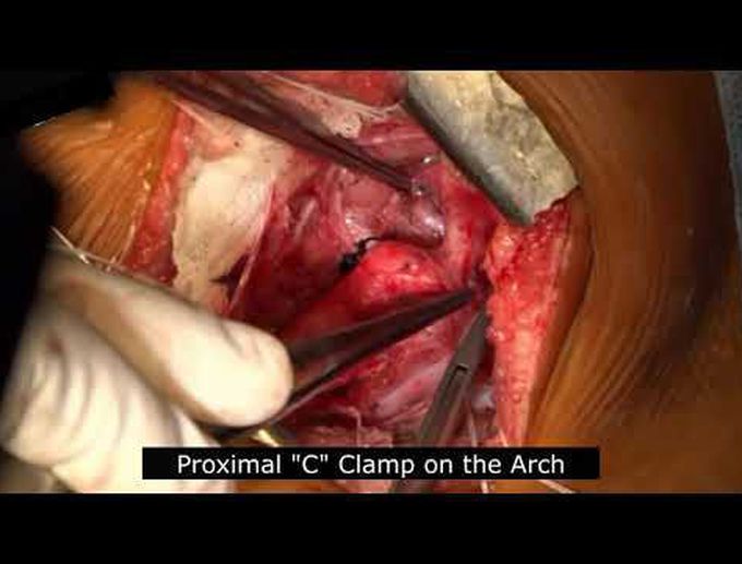 Surgical Repair for Coarctation of the Aorta