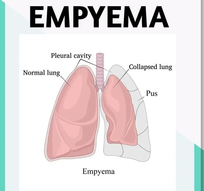 Emphysema