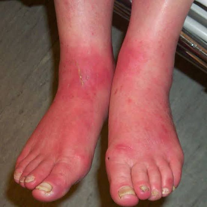 Causes of burning feet syndrome