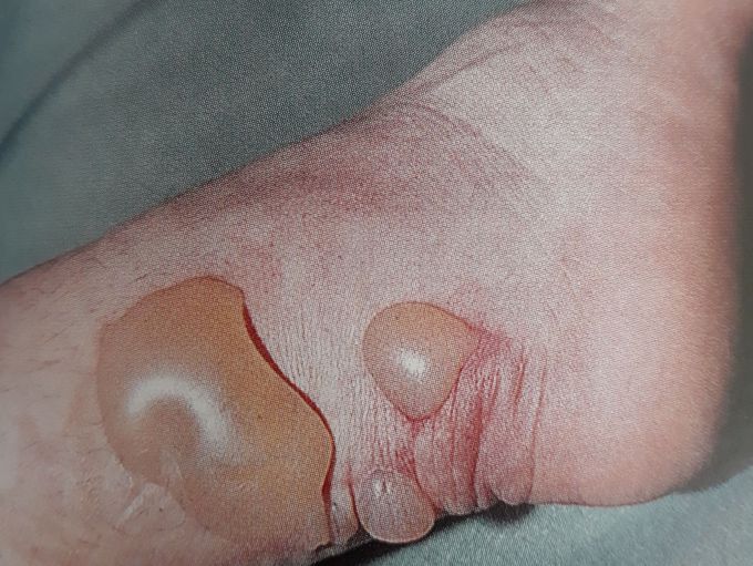 Second degree burn
