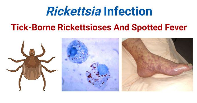 Rickettsioses