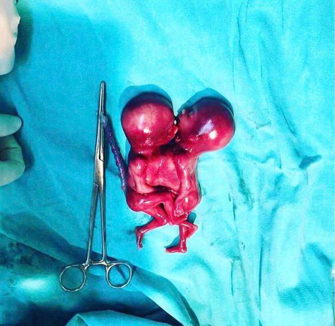 Conjoined twins