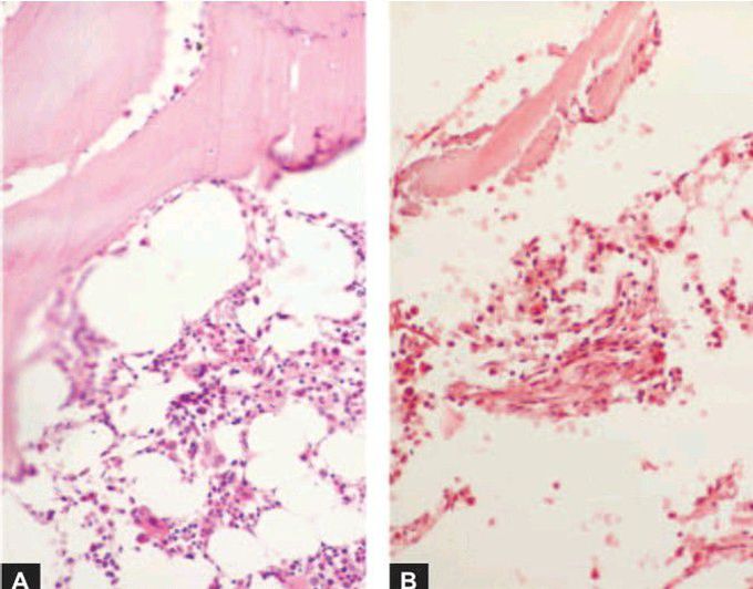 Biopsy in aplastic anaemia