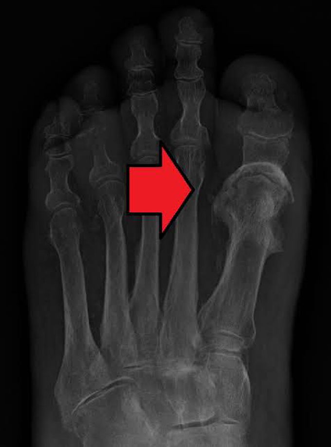 Osteomyelitis