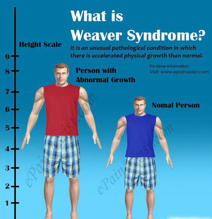Weaver Syndrome