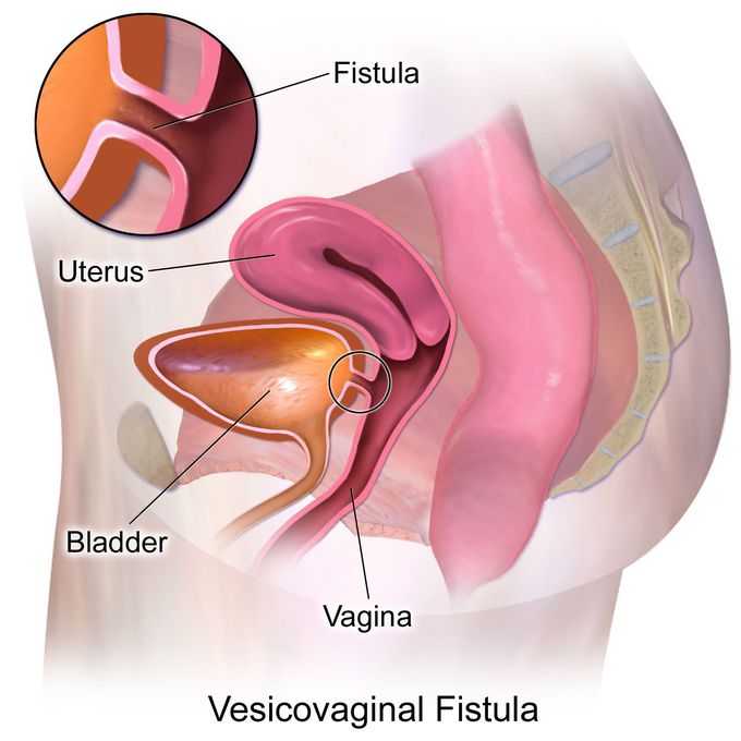 Vesicovaginal fistula