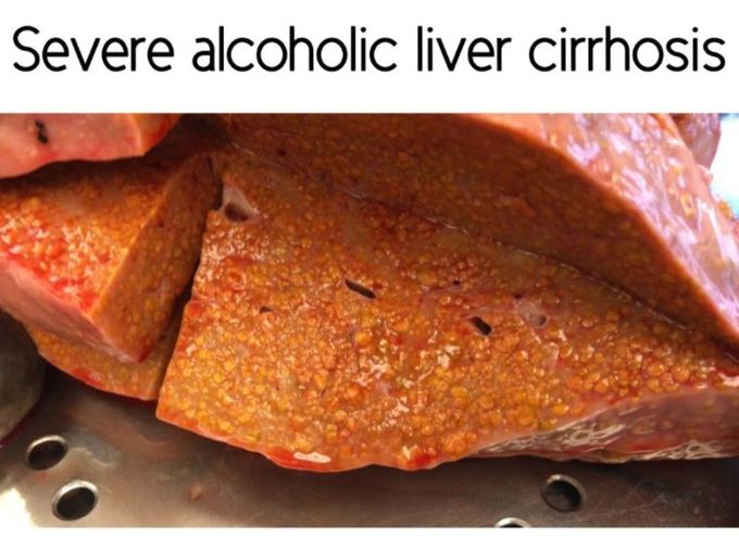 Severe Alcoholic Liver Cirrhosis