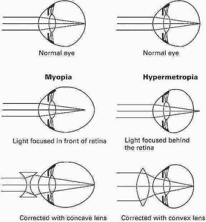 Refractive Disorders