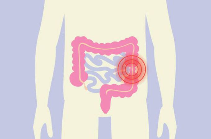 Management of irritable bowel syndrome