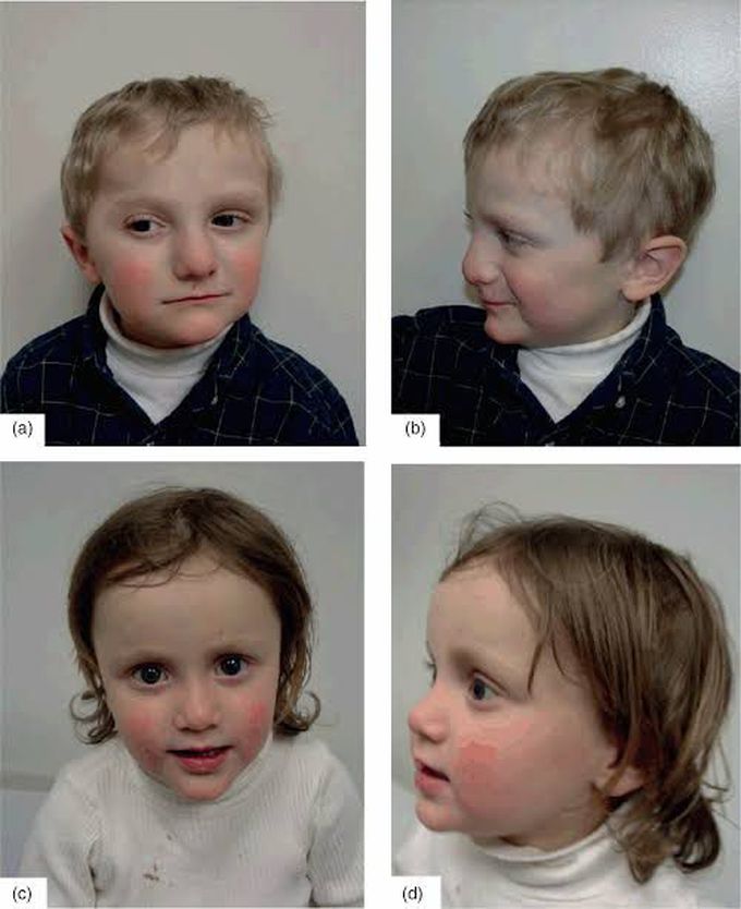 Allagile syndrome