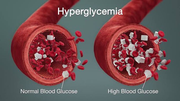 Hyperglycemia