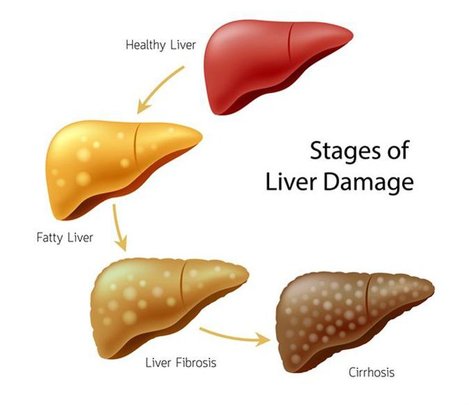 Stages of Cirrhosis of liver