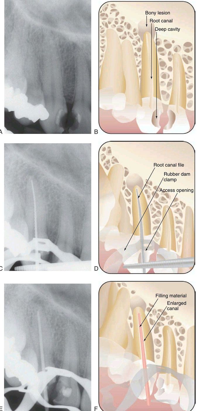 Root canal treatment of canine