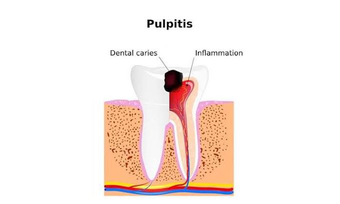 Symptoms of pulpitis