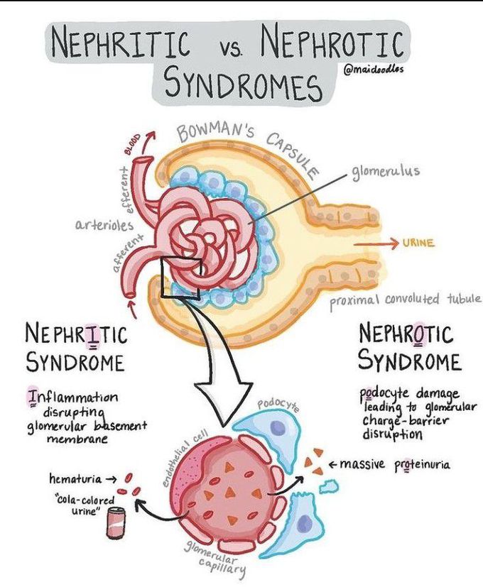 Nephritic vs Nephrotic syndrome
