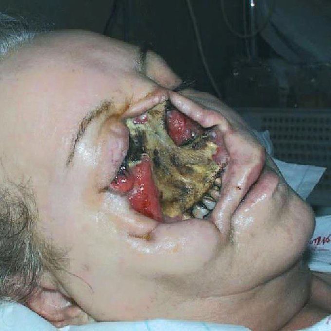 Combined Cranial Mucormycosis and Aspergillosis! 