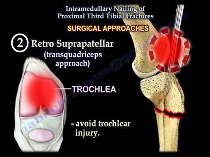 Proximal tibial fractures-Intramedullary nailing