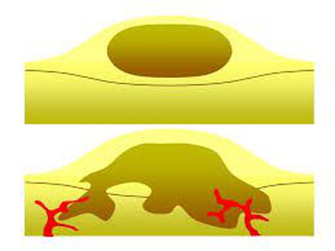 benign tumor
