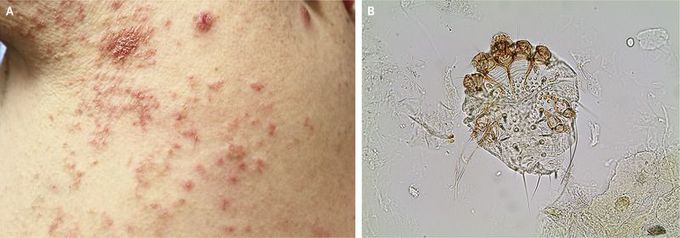 Scabies