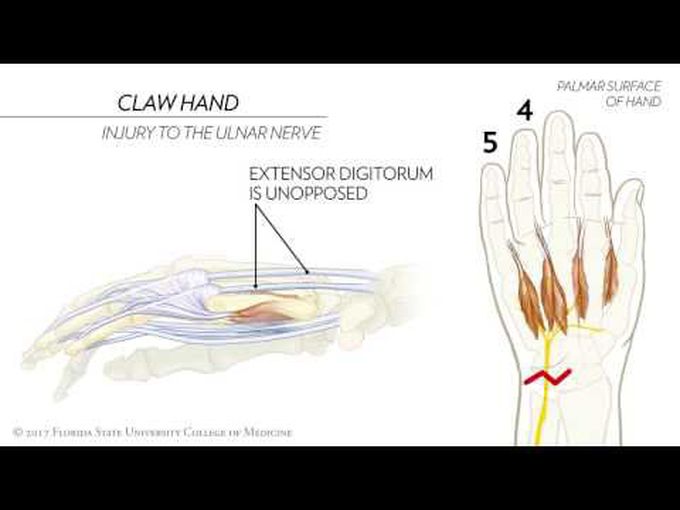 Injury to Median and Ulnar Nerve- Claw Hand, Ape Hand and Sign of Benediction 3D tutorial