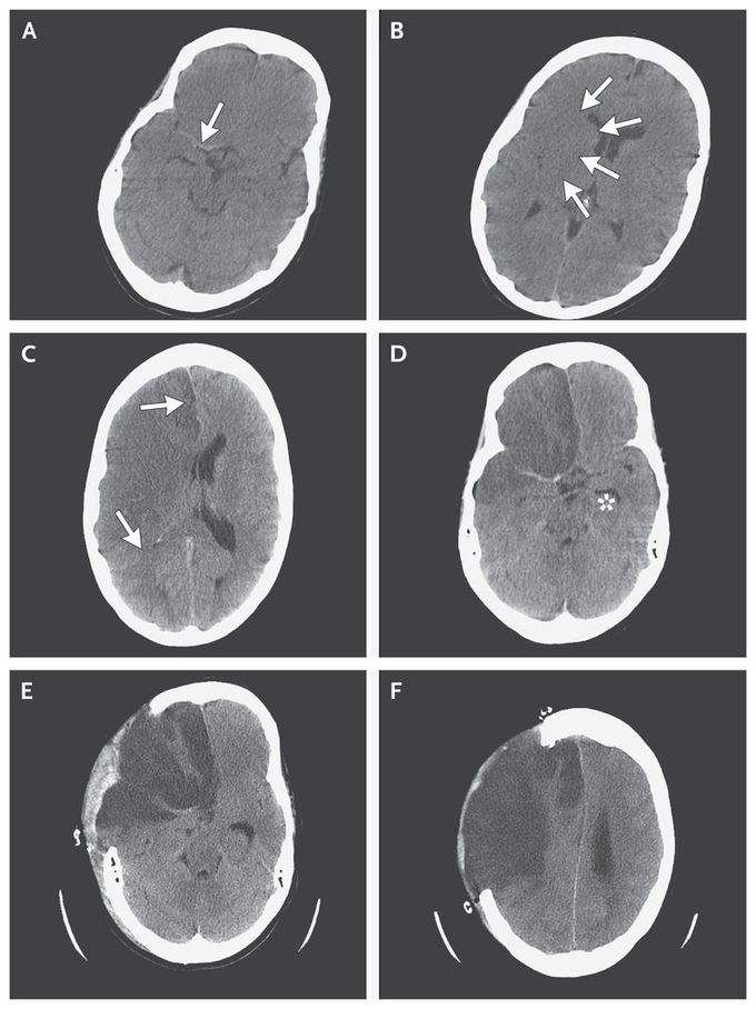 Evolving Infarction in the Anterior Circulation