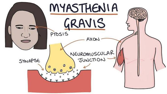 Treatment of myasthenia gravis