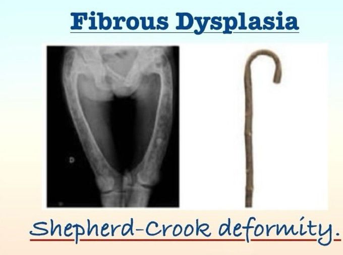 Fibrous Dysplasia