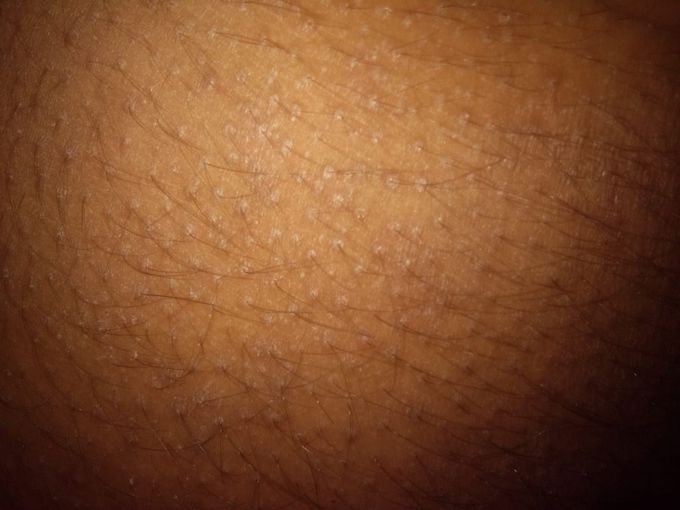 Follicular prominences for last 10 years with itching. What is your dignosis