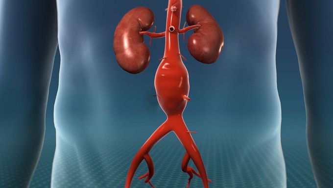 An aortic aneurysm is a balloon-like bulge in the aorta, the large artery that carries blood from the heart through the chest and torso.

Aortic aneurysms can dissect or rupture:

The force of blood pumping can split the layers of the artery wall, allowing blood to leak in between them. This process is called a dissection.
The aneurysm can burst completely, causing bleeding inside the body. This is called a rupture.
Dissections and ruptures are the cause of most deaths from aortic aneurysms.